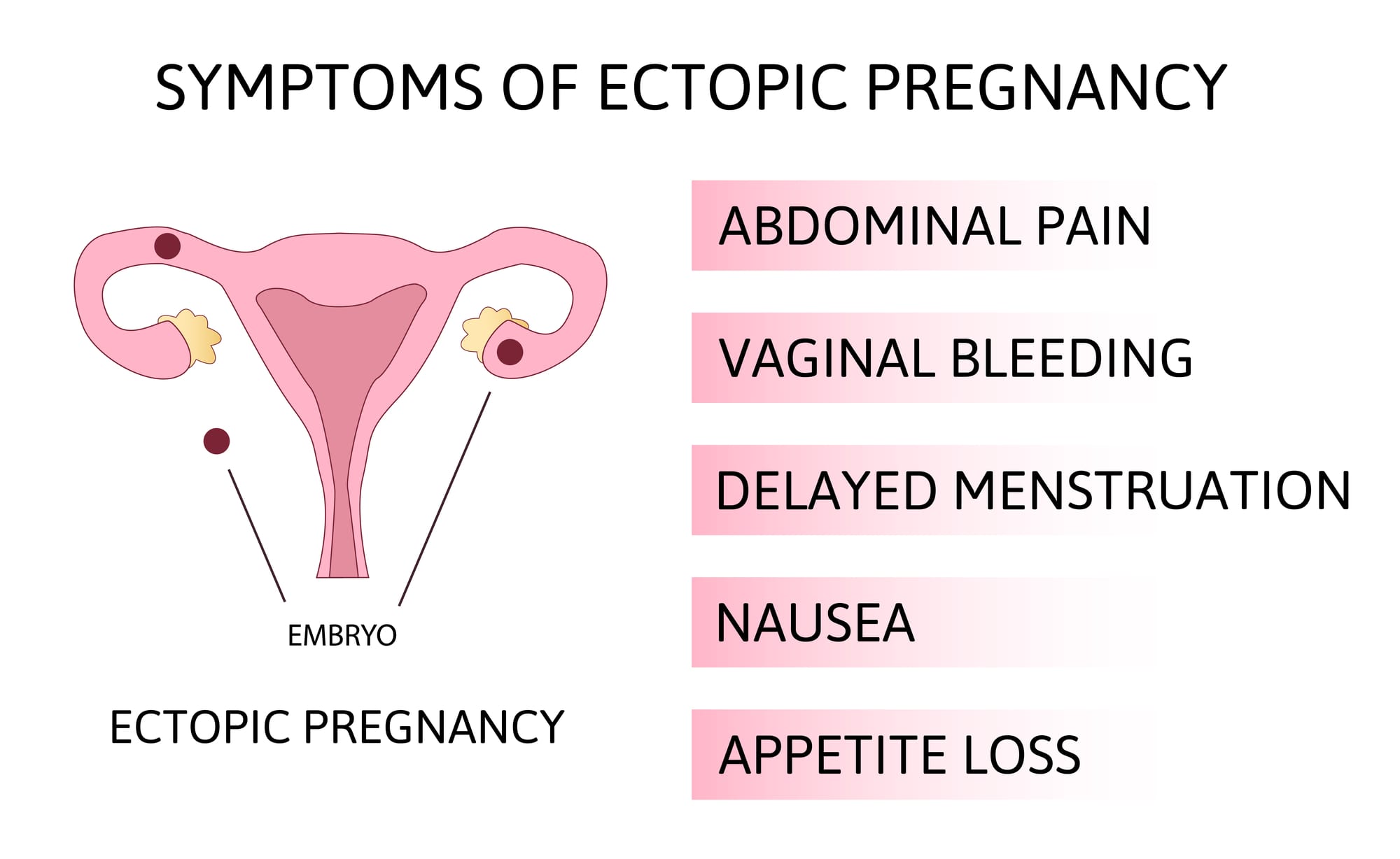 Signs of an Ectopic Pregnancy This Little Nest